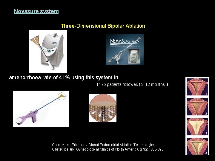 Novasure system Three-Dimensional Bipolar Ablation amenorrhoea rate of 41% using this system in (