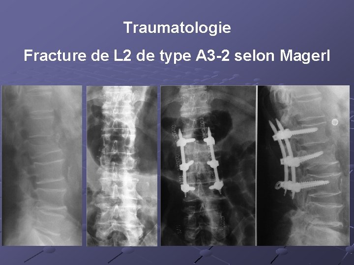 Traumatologie Fracture de L 2 de type A 3 -2 selon Magerl 