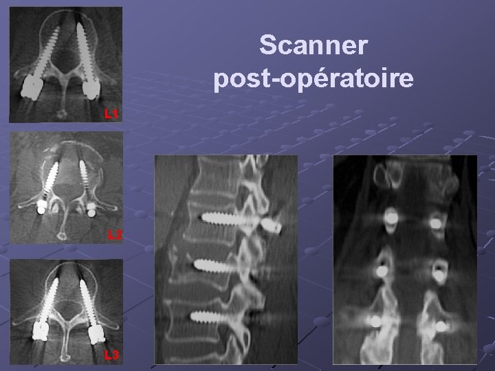 Scanner post-opératoire L 1 L 2 L 3 