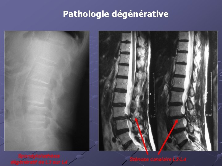 Pathologie dégénérative Spondylolisthésis dégénératif de L 3 sur L 4 Sténose canalaire L 3