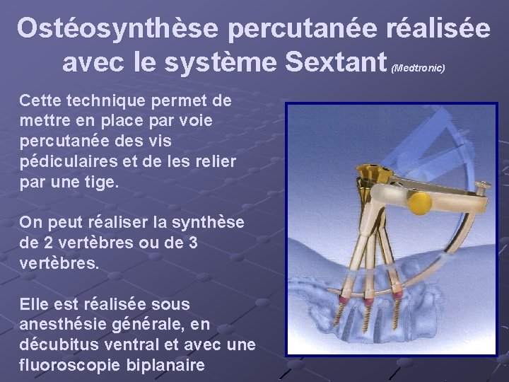 Ostéosynthèse percutanée réalisée avec le système Sextant (Medtronic) Cette technique permet de mettre en