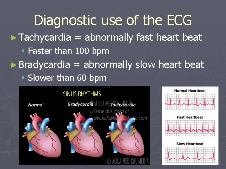 Diagnostic use of the ECG ► Tachycardia = abnormally fast heart beat § Faster