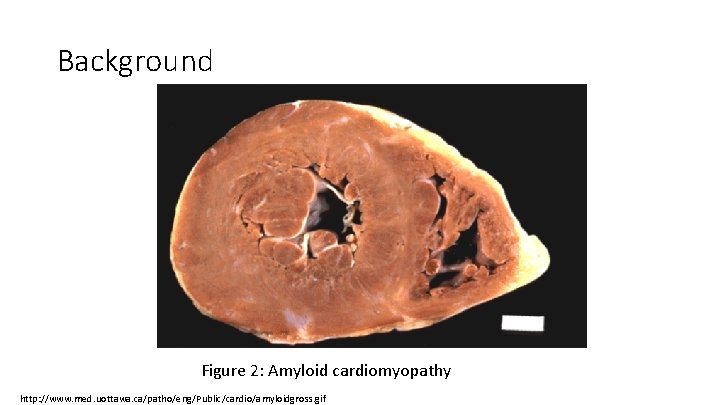 Background Figure 2: Amyloid cardiomyopathy http: //www. med. uottawa. ca/patho/eng/Public/cardio/amyloidgross. gif 