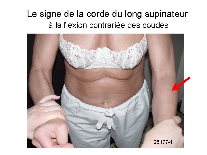 Le signe de la corde du long supinateur à la flexion contrariée des coudes