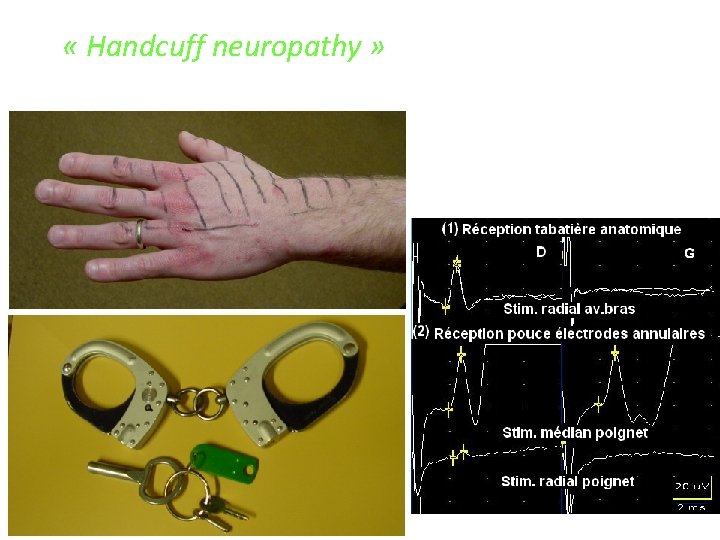  « Handcuff neuropathy » 35645 -1 M 28 ans (1983) Æ antécédent sauf