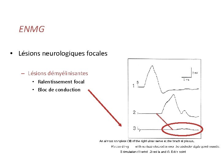 ENMG • Lésions neurologiques focales – Lésions démyélinisantes • Ralentissement focal • Bloc de