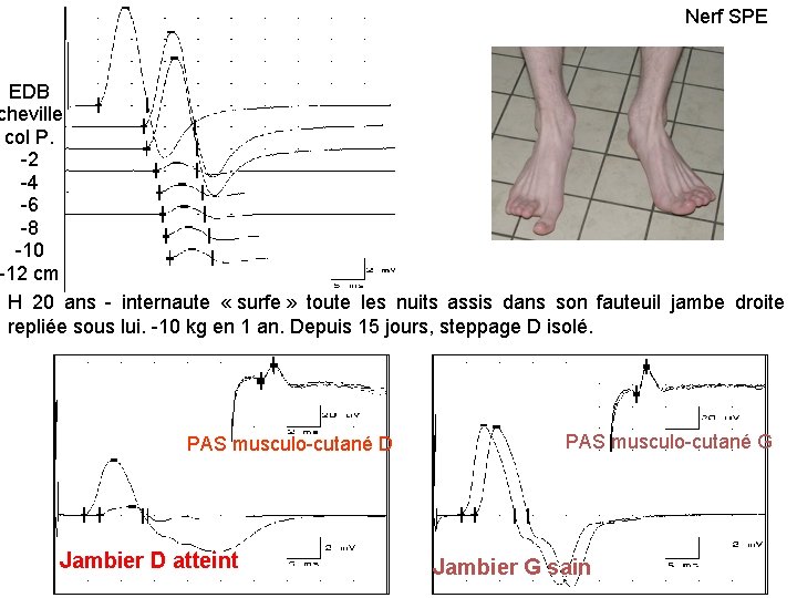 Nerf SPE EDB cheville col P. -2 -4 -6 -8 -10 -12 cm H