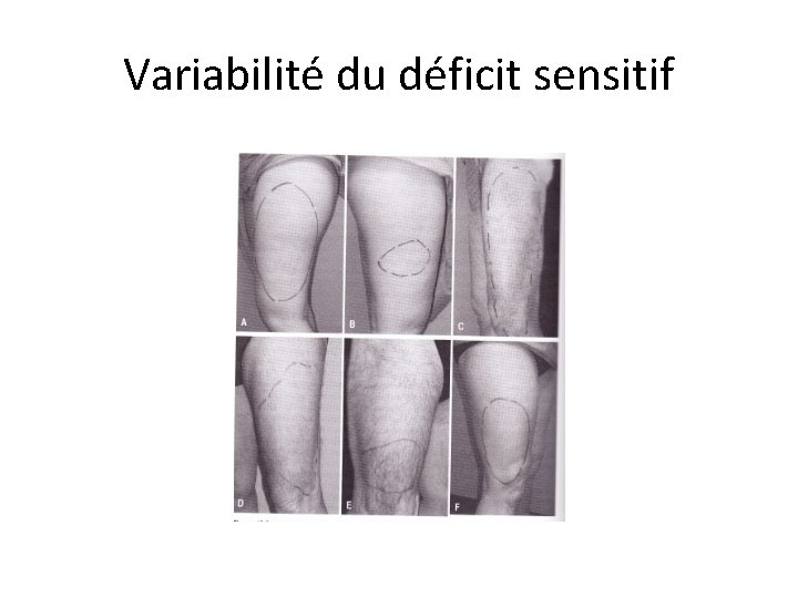 Variabilité du déficit sensitif 