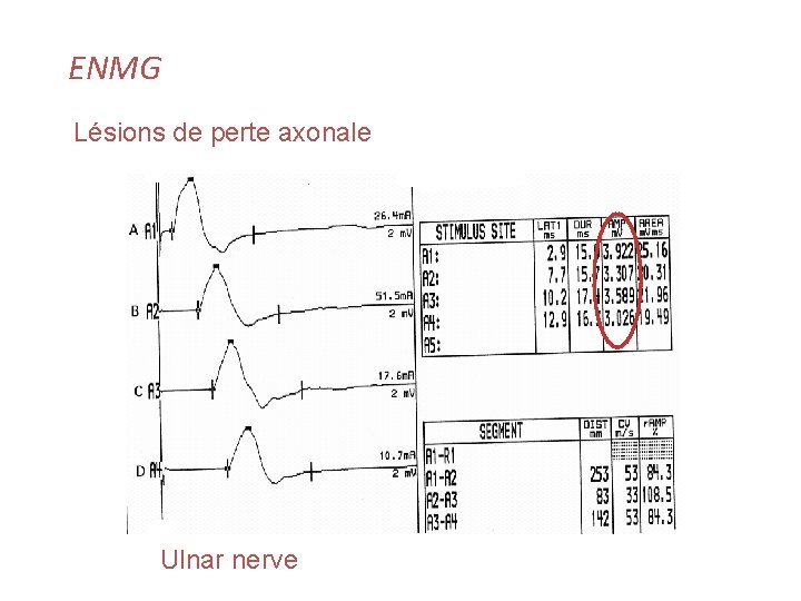 ENMG Lésions de perte axonale Ulnar nerve 