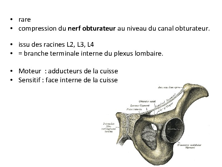  • rare • compression du nerf obturateur au niveau du canal obturateur. •