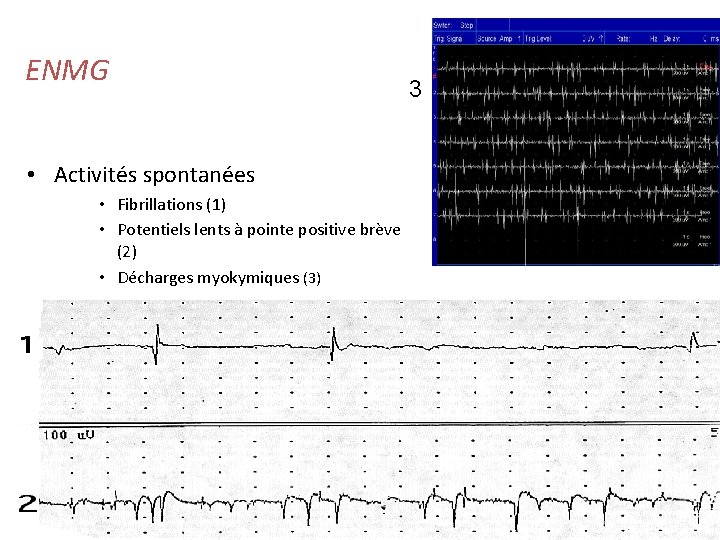 ENMG 3 • Activités spontanées • Fibrillations (1) • Potentiels lents à pointe positive