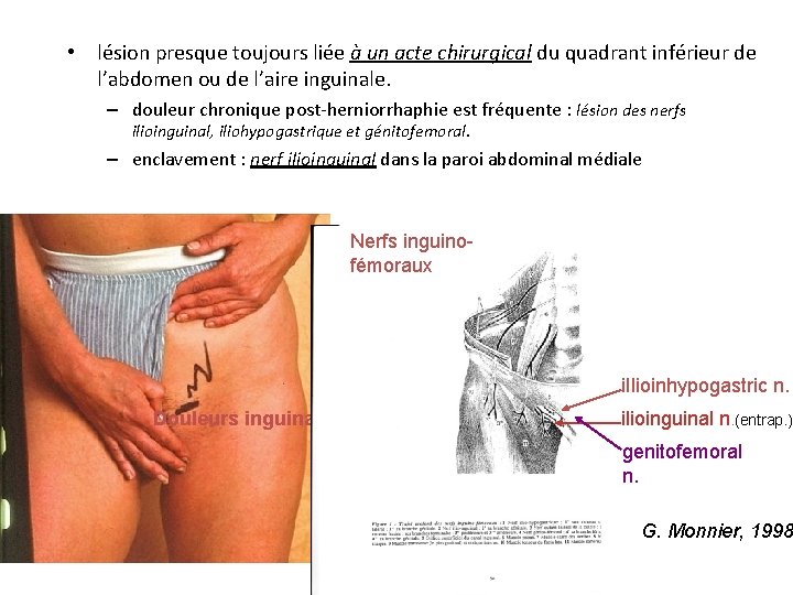  • lésion presque toujours liée à un acte chirurgical du quadrant inférieur de