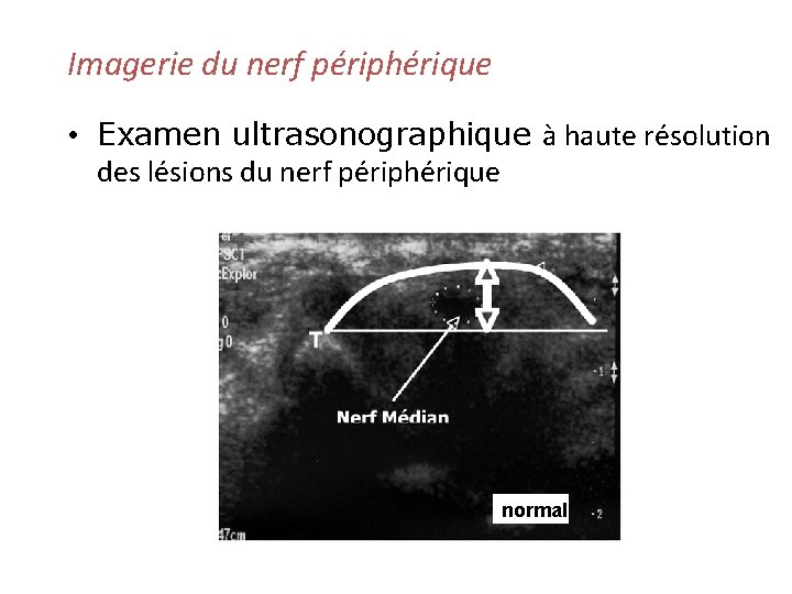 Imagerie du nerf périphérique • Examen ultrasonographique à haute résolution des lésions du nerf