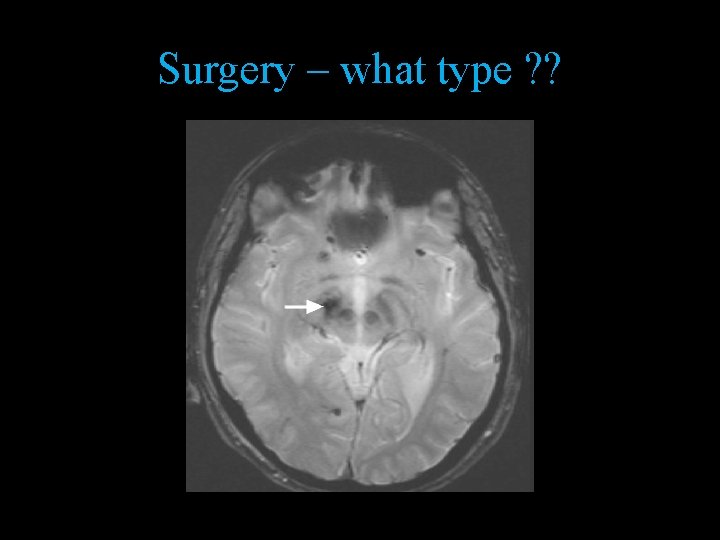 Surgery – what type ? ? 