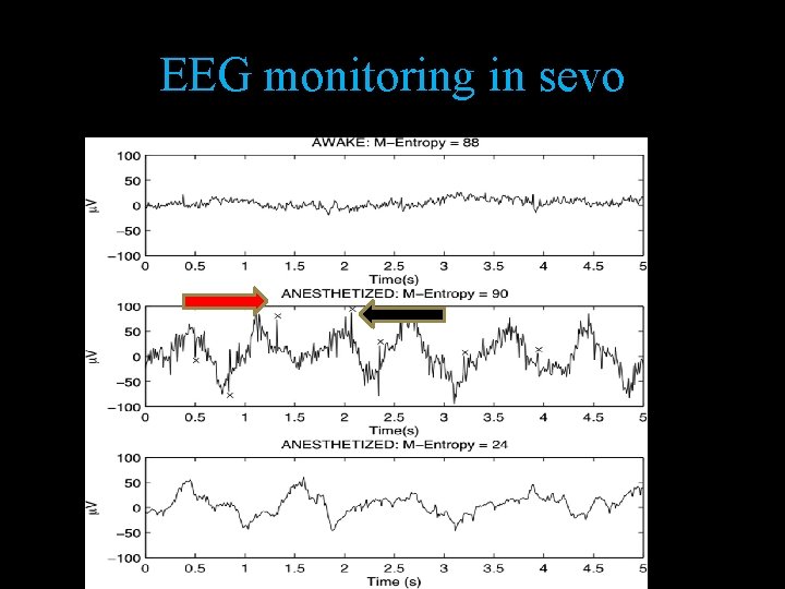 EEG monitoring in sevo 