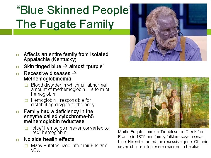 “Blue Skinned People” The Fugate Family Affects an entire family from isolated Appalachia (Kentucky)