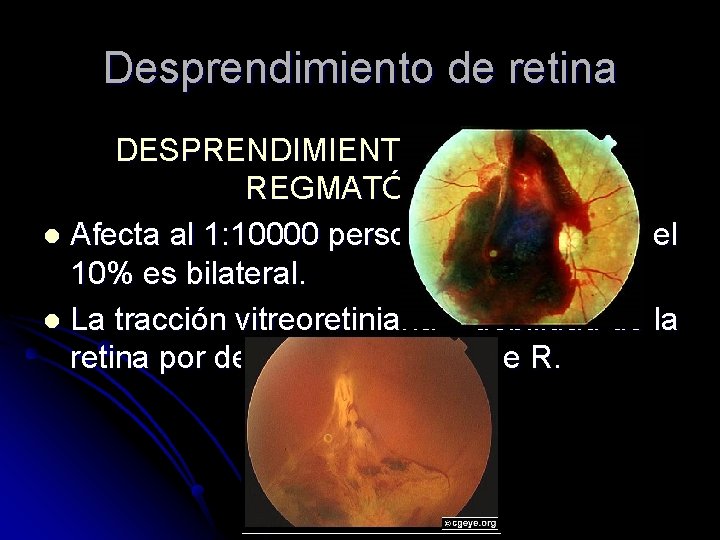 Desprendimiento de retina DESPRENDIMIENTO DE RETINA REGMATÓGENO l Afecta al 1: 10000 personas anualmente,