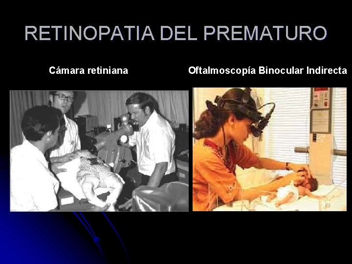 RETINOPATIA DEL PREMATURO Cámara retiniana Oftalmoscopía Binocular Indirecta 