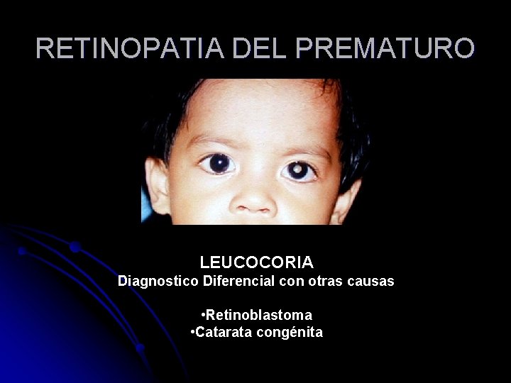 RETINOPATIA DEL PREMATURO LEUCOCORIA Diagnostico Diferencial con otras causas • Retinoblastoma • Catarata congénita