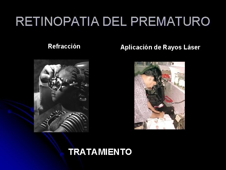 RETINOPATIA DEL PREMATURO Refracción Aplicación de Rayos Láser TRATAMIENTO 