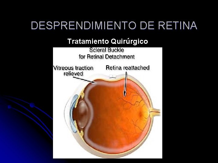 DESPRENDIMIENTO DE RETINA Tratamiento Quirúrgico 