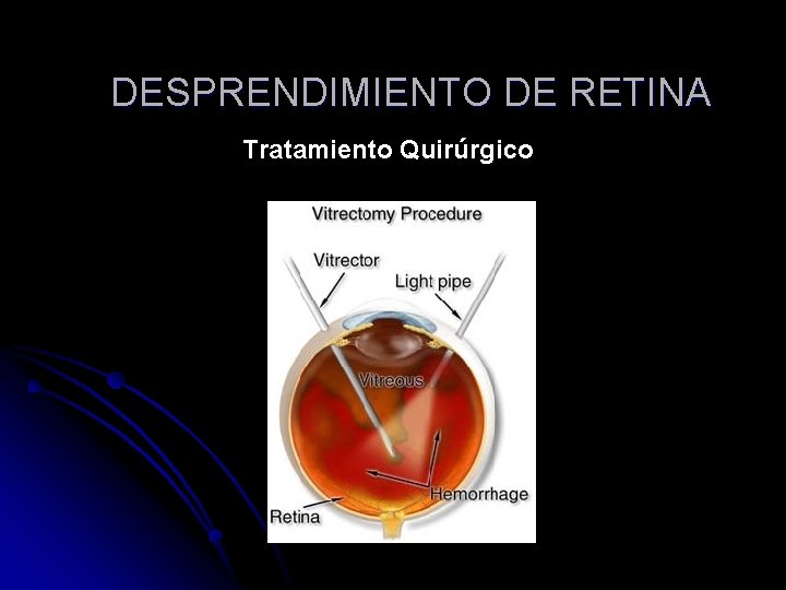 DESPRENDIMIENTO DE RETINA Tratamiento Quirúrgico 