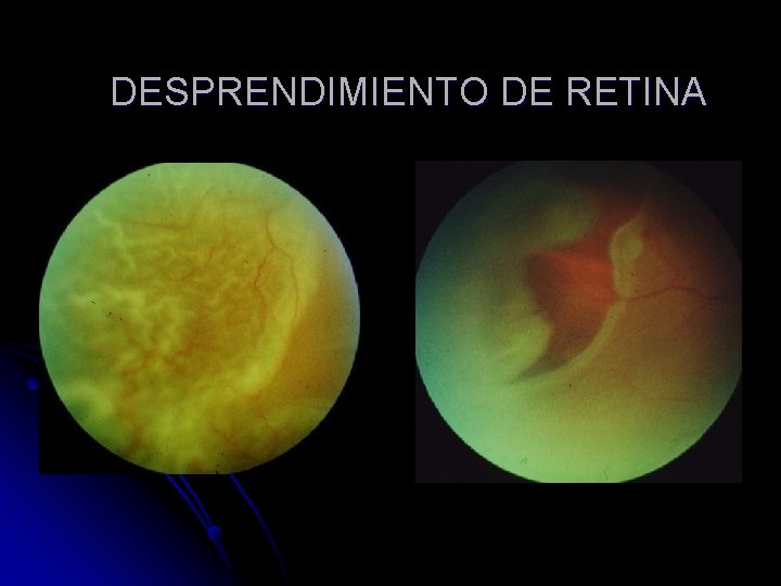 DESPRENDIMIENTO DE RETINA 