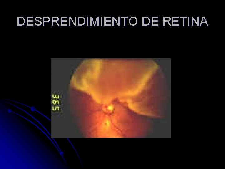 DESPRENDIMIENTO DE RETINA 