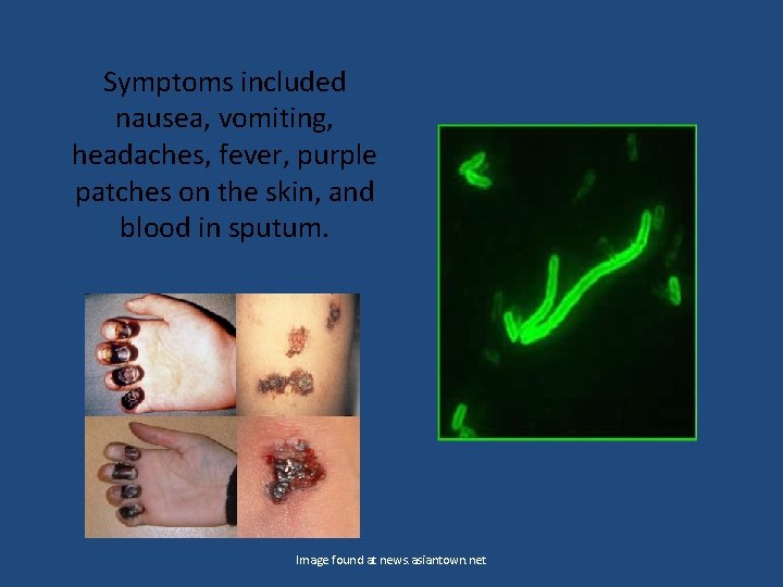Symptoms included nausea, vomiting, headaches, fever, purple patches on the skin, and blood in