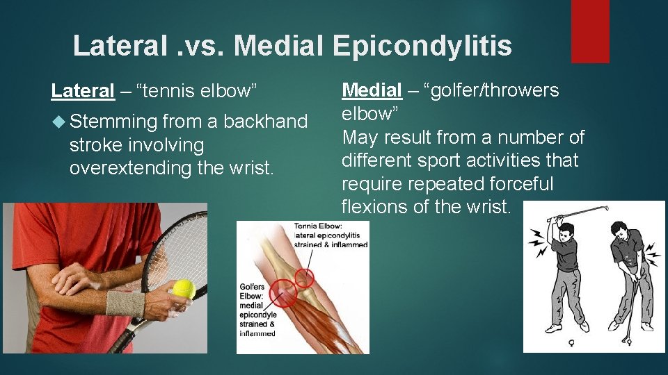 Lateral. vs. Medial Epicondylitis Lateral – “tennis elbow” Stemming from a backhand stroke involving