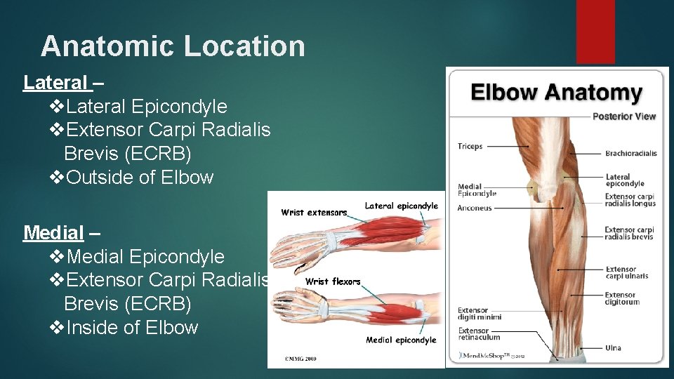 Anatomic Location Lateral – v. Lateral Epicondyle v. Extensor Carpi Radialis Brevis (ECRB) v.