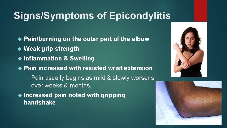 Signs/Symptoms of Epicondylitis Pain/burning Weak grip strength Inflammation Pain on the outer part of