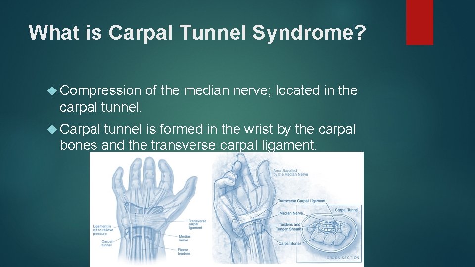 What is Carpal Tunnel Syndrome? Compression of the median nerve; located in the carpal