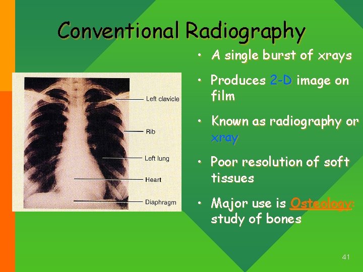 Conventional Radiography • A single burst of xrays • Produces 2 -D image on