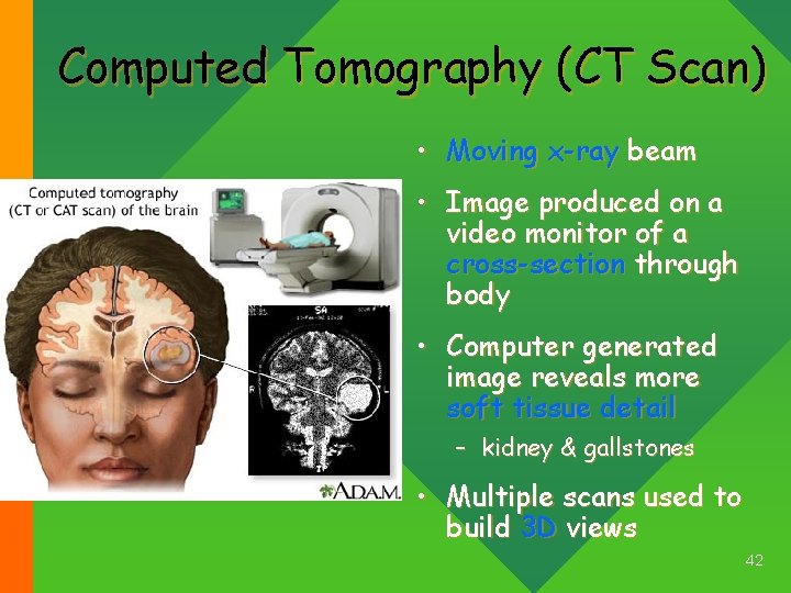 Computed Tomography (CT Scan) • Moving x-ray beam • Image produced on a video