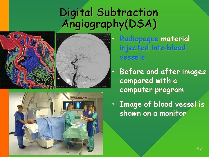 Digital Subtraction Angiography(DSA) • Radiopaque material injected into blood vessels • Before and after