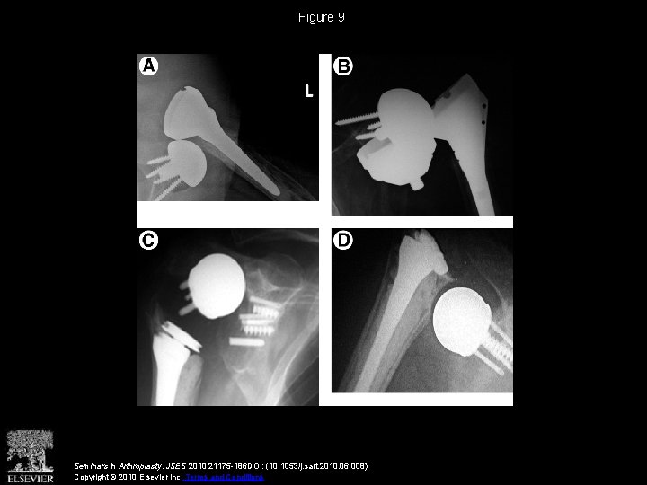 Figure 9 Seminars in Arthroplasty: JSES 2010 21175 -186 DOI: (10. 1053/j. sart. 2010.