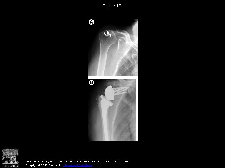 Figure 10 Seminars in Arthroplasty: JSES 2010 21175 -186 DOI: (10. 1053/j. sart. 2010.