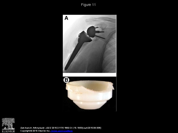 Figure 11 Seminars in Arthroplasty: JSES 2010 21175 -186 DOI: (10. 1053/j. sart. 2010.