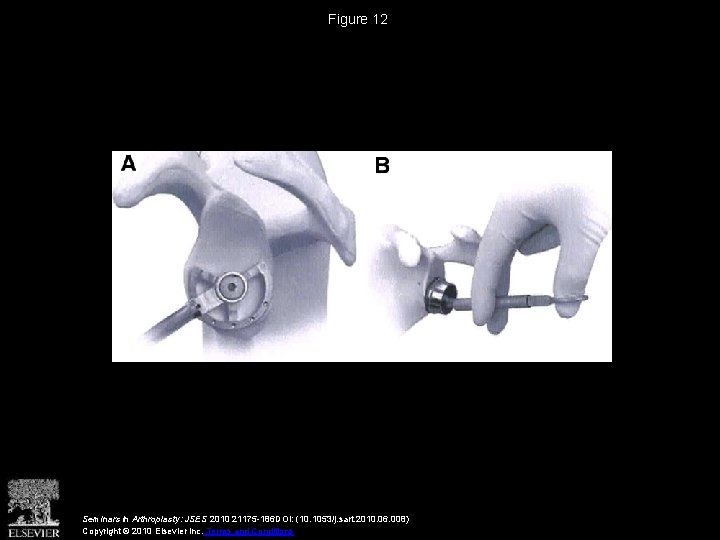 Figure 12 Seminars in Arthroplasty: JSES 2010 21175 -186 DOI: (10. 1053/j. sart. 2010.