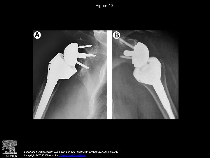 Figure 13 Seminars in Arthroplasty: JSES 2010 21175 -186 DOI: (10. 1053/j. sart. 2010.