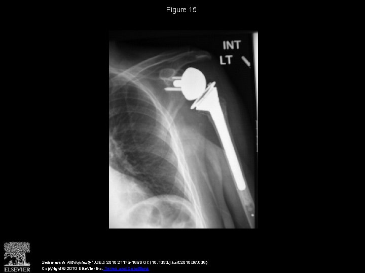 Figure 15 Seminars in Arthroplasty: JSES 2010 21175 -186 DOI: (10. 1053/j. sart. 2010.