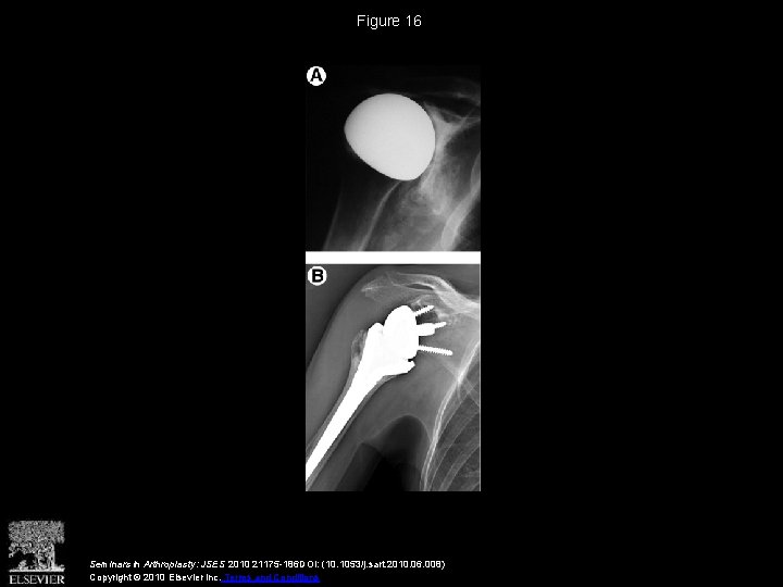 Figure 16 Seminars in Arthroplasty: JSES 2010 21175 -186 DOI: (10. 1053/j. sart. 2010.