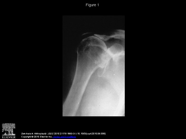 Figure 1 Seminars in Arthroplasty: JSES 2010 21175 -186 DOI: (10. 1053/j. sart. 2010.