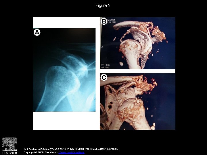 Figure 2 Seminars in Arthroplasty: JSES 2010 21175 -186 DOI: (10. 1053/j. sart. 2010.