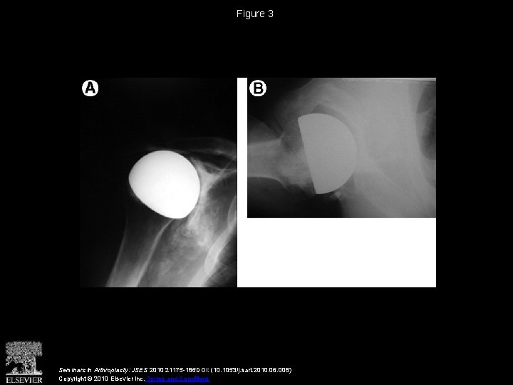 Figure 3 Seminars in Arthroplasty: JSES 2010 21175 -186 DOI: (10. 1053/j. sart. 2010.