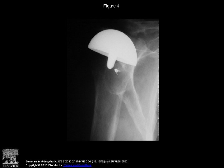 Figure 4 Seminars in Arthroplasty: JSES 2010 21175 -186 DOI: (10. 1053/j. sart. 2010.