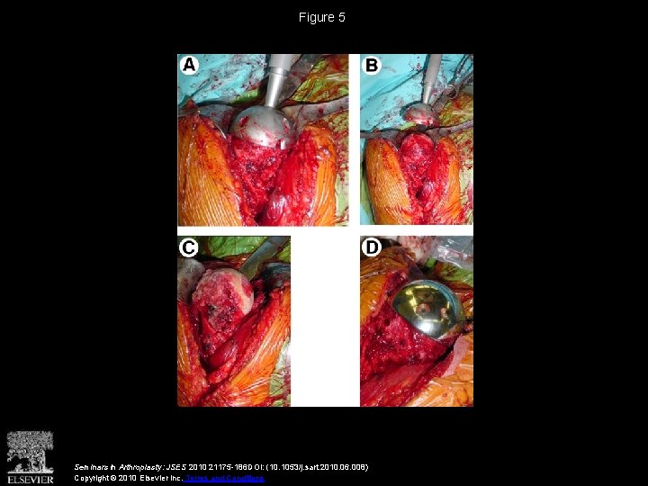 Figure 5 Seminars in Arthroplasty: JSES 2010 21175 -186 DOI: (10. 1053/j. sart. 2010.