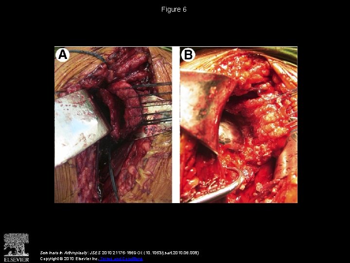 Figure 6 Seminars in Arthroplasty: JSES 2010 21175 -186 DOI: (10. 1053/j. sart. 2010.