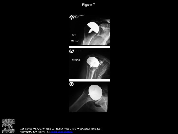 Figure 7 Seminars in Arthroplasty: JSES 2010 21175 -186 DOI: (10. 1053/j. sart. 2010.